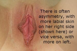 labiaplasty san diego labia reduction large labia