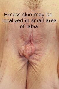 labiaplasty san diego large labia labia reduction